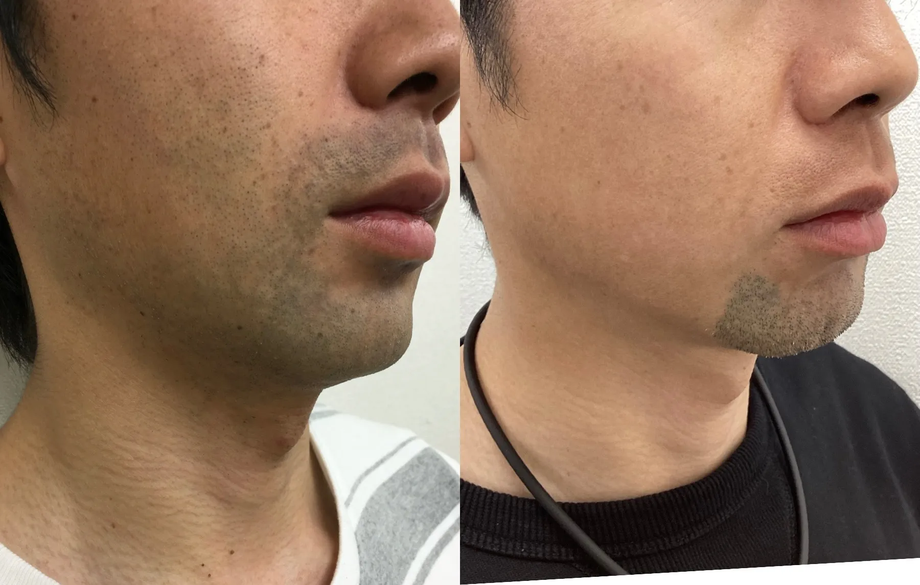 メンズヒゲ脱毛&メンズ光フェイシャル