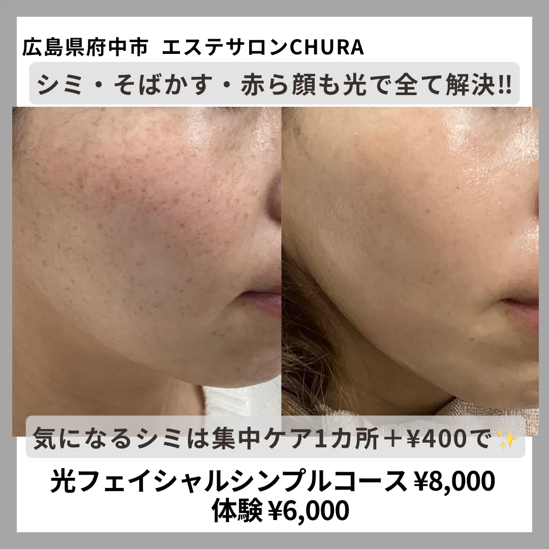シミそばかす/美白もお任せください!/広島県府中市で本格的なフェイシャルエステ